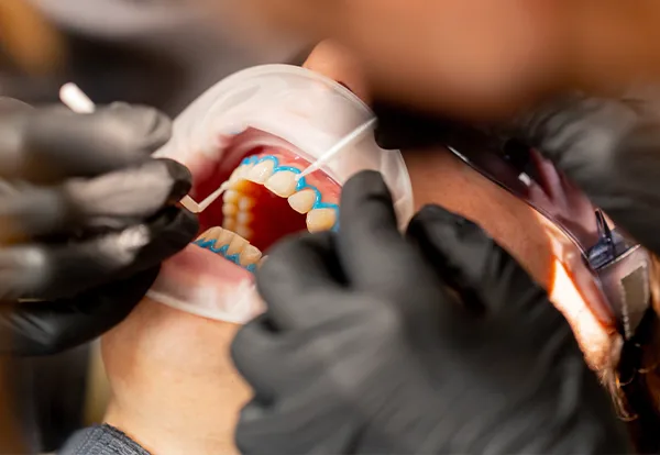 diş tedavileri diş beyazlatma